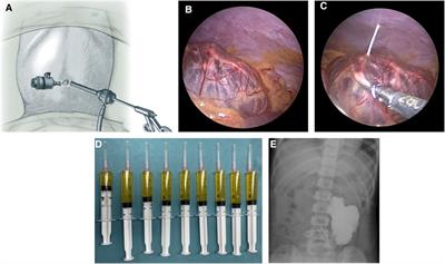 Laparoscopic-assisted sclerotherapy in pediatric retroperitoneal lymphatic malformations